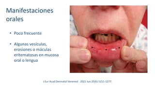Manifestaciones
orales
• Poco frecuente
• Algunas vesículas,
erosiones o máculas
eritematosas en mucosa
oral o lengua
J Eur Acad Dermatol Venereol . 2021 Jun;35(6):1251-1277.
 