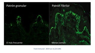Patrón granular Patrón fibrilar
Front Immunol . 2019 Jun 11;10:1290.
Menos común
El más frecuente
 