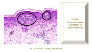 También
microabscesos de
neutrófilos en
papilas dérmicas
Am J Clin Dermatol . 2021 May;22(3):329-338.
 