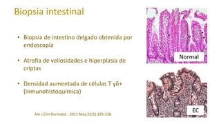 Biopsia intestinal
Normal
EC
• Biopsia de intestino delgado obtenida por
endoscopía
• Atrofia de vellosidades e hiperplasia de
criptas
• Densidad aumentada de células T ɣδ+
(inmunohistoquímica)
Am J Clin Dermatol . 2021 May;22(3):329-338.
 