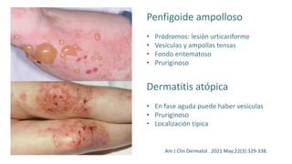 Penfigoide ampolloso
• Pródromos: lesión urticariforme
• Vesículas y ampollas tensas
• Fondo eritematoso
• Pruriginoso
Dermatitis atópica
• En fase aguda puede haber vesículas
• Pruriginoso
• Localización típica
Am J Clin Dermatol . 2021 May;22(3):329-338.
 