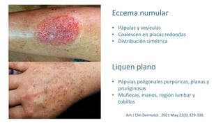 Eccema numular
• Pápulas y vesículas
• Coalescen en placas redondas
• Distribución simétrica
Liquen plano
• Pápulas poligonales purpúricas, planas y
pruriginosas
• Muñecas, manos, región lumbar y
tobillos
Am J Clin Dermatol . 2021 May;22(3):329-338.
 