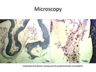 Microscopy
subepidermal blister composed of predominantly neutrophils
10x 40x
 