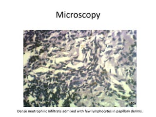 Microscopy
40x
Dense neutrophilic infiltrate admixed with few lymphocytes in papillary dermis.
 