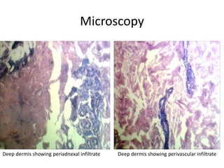 Microscopy
Deep dermis showing periadnexal infiltrate Deep dermis showing perivascular infiltrate
 