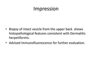 Impression
• Biopsy of intact vesicle from the upper back shows
histopathological features consistent with Dermatitis
herpetiformis.
• Advised Immunofluorescence for further evaluation.
 