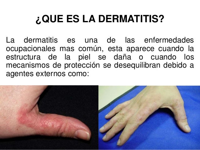 Como sanar la cabeza de la caspa a la psoriasis
