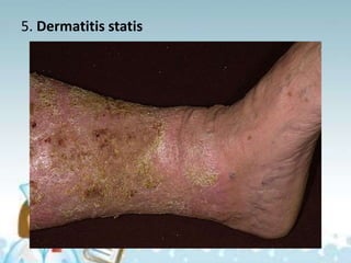 5. Dermatitis statis
 