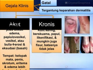 Gejala Klinis
Gatal
Akut
Bercak
eritematous, batas
jelas diikuti
edema,
papiulovesikel,
vesikel, atau
bullaerosi &
eksudasi (basah)
Tempat: kelopak
mata, penis,
skrotum, eritema
& edema lebih
Kronis
Kulit kering,
berskuama, papul,
likenifikasi, &
mungkin juga
fisur, batasnya
tidak jelas
Tergantung keparahan dermatitis
 