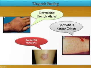 Dermatitis
Kontak Alergi
Dermatitis
Kontak Iritan
Dermatitis
Numularis
 