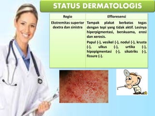 Regio Effloresensi
Ekstremitas superior
dextra dan sinistra
Tampak plakat berbatas tegas
dengan tepi yang tidak aktif. Lesinya
hiperpigmentasi, berskuama, erosi
dan xerosis.
Papul (-), vesikel (-), nodul (-), krusta
(-), ulkus (-), urtika (-),
hipopigmentasi (-), sikatriks (-),
fissure (-).
STATUS DERMATOLOGIS
 