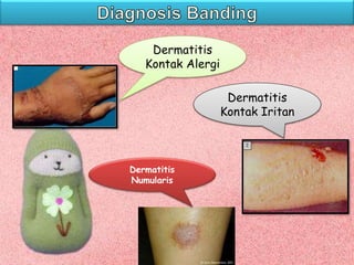 Dermatitis
Kontak Alergi
Dermatitis
Kontak Iritan
Dermatitis
Numularis
 