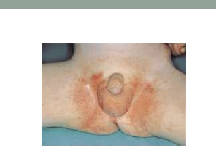 Que curar la psoriasis sobre el prepucio
