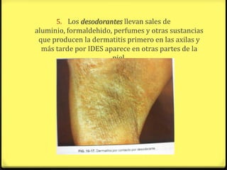 5. Los desodorantes llevan sales de
aluminio, formaldehido, perfumes y otras sustancias
 que producen la dermatitis primero en las axilas y
  más tarde por IDES aparece en otras partes de la
                       piel.
 