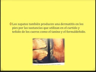 0 Los zapatos también producen una dermatitis en los
 pies por las sustancias que utilizan en el curtido y
 teñido de los cueros como el tanino y el formaldehido.
 