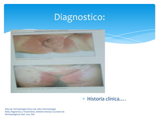 Diagnostico:




                                                                  Historia clínica….
Atlas de Dermatología Clínica 2da. Edit.// Dermatología
Atlás, Diagnóstico y Tratamiento, Roberto Arenas// Lecciones de
Dermatología de Saúl. 15va. Edit.
 