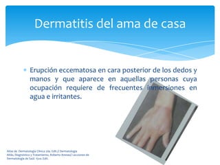 Dermatitis del ama de casa


                 Erupción eccematosa en cara posterior de los dedos y
                 manos y que aparece en aquellas personas cuya
                 ocupación requiere de frecuentes inmersiones en
                 agua e irritantes.




Atlas de Dermatología Clínica 2da. Edit.// Dermatología
Atlás, Diagnóstico y Tratamiento, Roberto Arenas// Lecciones de
Dermatología de Saúl. 15va. Edit.
 