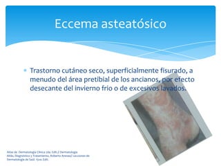 Eccema asteatósico


                 Trastorno cutáneo seco, superficialmente fisurado, a
                 menudo del área pretibial de los ancianos, por efecto
                 desecante del invierno frio o de excesivos lavados.




Atlas de Dermatología Clínica 2da. Edit.// Dermatología
Atlás, Diagnóstico y Tratamiento, Roberto Arenas// Lecciones de
Dermatología de Saúl. 15va. Edit.
 