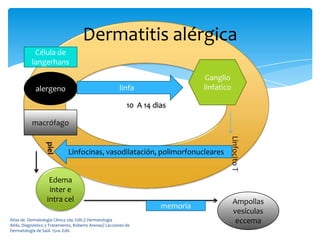 Dermatitis alérgica
            Célula de
           langerhans
                                                                                 Ganglio
             alergeno                                    linfa                   linfatico

                                                             10 A 14 dias

           macrófago




                                                                                         Linfocito T
                  piel




                              Linfocinas, vasodilatación, polimorfonucleares


                    Edema
                    inter e
                   intra cel                                                                 Ampollas
                                                                       memoria
                                                                                             vesículas
Atlas de Dermatología Clínica 2da. Edit.// Dermatología
Atlás, Diagnóstico y Tratamiento, Roberto Arenas// Lecciones de
                                                                                              eccema
Dermatología de Saúl. 15va. Edit.
 