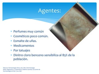 Agentes:


                 Perfumes muy común
                 Cosméticos poco común.
                 Esmalte de uñas.
                 Medicamentos
                 Por tatuajes
                 Dinitro cloro benceno sensibiliza al 85% de la
                 población.

Atlas de Dermatología Clínica 2da. Edit.// Dermatología
Atlás, Diagnóstico y Tratamiento, Roberto Arenas// Lecciones de
Dermatología de Saúl. 15va. Edit.
 