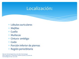 Localización:


                 Lóbulos auriculares
                 Mejillas
                 Cuello
                 Muñecas
                 Cintura- ombligo
                 Codo
                 Porción inferior de piernas
                 Región periorbitaria
Atlas de Dermatología Clínica 2da. Edit.// Dermatología
Atlás, Diagnóstico y Tratamiento, Roberto Arenas// Lecciones de
Dermatología de Saúl. 15va. Edit.
 