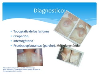 Diagnostico:


                 Topografia de las lesiones
                 Ocupación.
                 interrogatorio
                 Pruebas epicutaneas (parche). Método estándar




Atlas de Dermatología Clínica 2da. Edit.// Dermatología
Atlás, Diagnóstico y Tratamiento, Roberto Arenas// Lecciones de
Dermatología de Saúl. 15va. Edit.
 