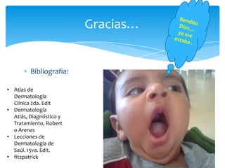 Gracias…


         Bibliografia:

• Atlas de
  Dermatología
  Clínica 2da. Edit
• Dermatología
  Atlás, Diagnóstico y
  Tratamiento, Robert
  o Arenas
• Lecciones de
  Dermatología de
  Saúl. 15va. Edit.
• fitzpatrick
 