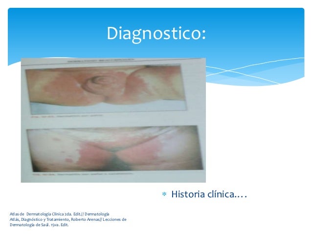 El tratamiento de la psoriasis escamas del pez
