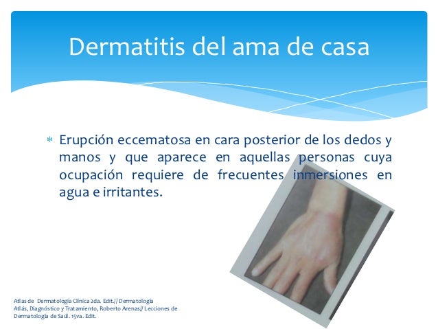 El tratamiento atopicheskogo de la dermatitis al homeópata