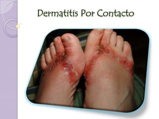 Dermatitis Por Contacto
 