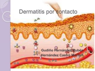 Dermatitis por contacto
•Gudiño Hernández Rubén
•Hernández Castro Marilyn
 