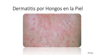 Dermatitis por Hongos en la Piel
Pitiriasis
 