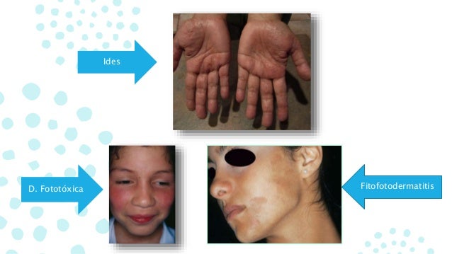 De que surge atopichesky la dermatitis a los niños