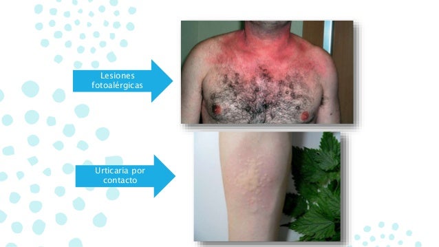 Los indicios de la psoriasis al niño