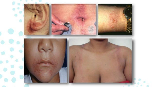 Que curar la psoriasis sobre las articulaciones