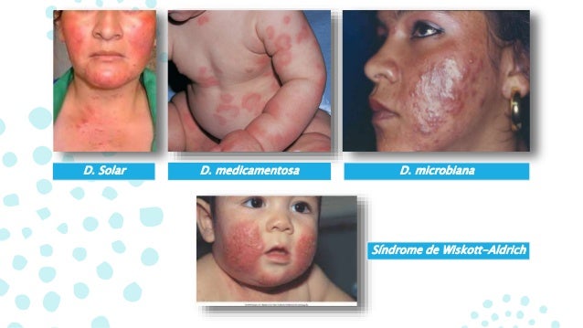 El champú para la psoriasis