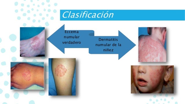 Como sanar la psoriasis en minske
