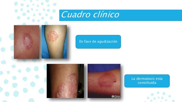 La raíz del regaliz a la psoriasis
