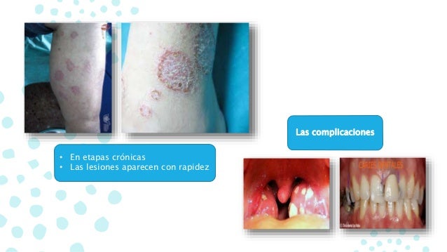 Lavarse la cabeza por la sosa a la psoriasis