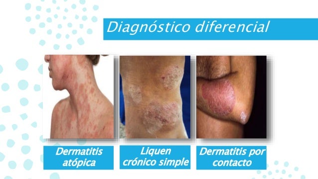 El hongo de las uñas la diferencia de la psoriasis de las uñas