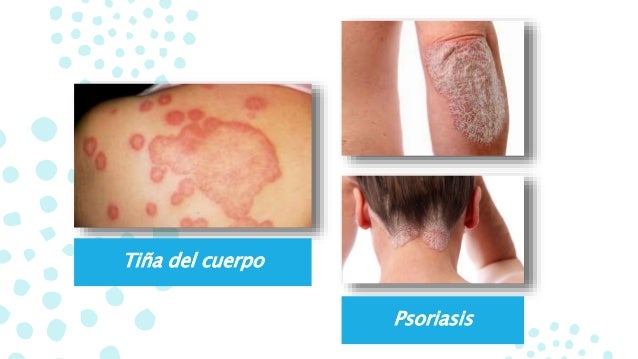 Dermatitis reaccionales