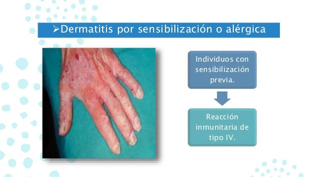 El ungüento de la psoriasis en la piel de los pies