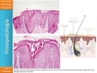 Generalidades
Epidemiologia
Etiopatogenia
   Histopatología




   Clínica
                    Dermatitis seborreica, Elisabeth Gómez Moyano, Ángel Vera Casaño, Vicente Crespo Erchiga, Servicio de Dermatología. Hospital Carlos Haya
 Tratamiento        (Málaga) Laboratorios Thea. 2007
 