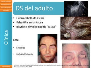 Generalidades
Epidemiologia
Etiopatogenia
  Histología        DS del adulto
                • Cuero cabelludo > cara
                • Falsa tiña amiantacea
                • pityriasis simplex capitis “caspa”
   Clínica




                Cara

                •   Simetrica

                •   Blefaritis(Meibomio)




                Dermatitis seborreica, Elisabeth Gómez Moyano, Ángel Vera Casaño, Vicente Crespo Erchiga, Servicio de Dermatología. Hospital Carlos Haya
 Tratamiento    (Málaga) Laboratorios Thea. 2007
 