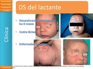 Generalidades
Epidemiologia
Etiopatogenia
  Histología
   Clínica                   DS del lactante




Dermatitis seborreica, Elisabeth Gómez Moyano, Ángel Vera Casaño, Vicente Crespo Erchiga, Servicio de Dermatología. Hospital Carlos Haya (Málaga)
Tratamiento
Laboratorios Thea. 2007
 