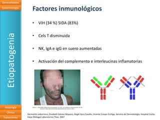 Generalidades
Epidemiologia
                        Factores inmunológicos
                        • VIH (34 %) SIDA (83%)
   Etiopatogenia

                        • Cels T disminuida

                        • NK, IgA e igG en suero aumentadas

                        • Activación del complemento e interleucinas inflamatorias




  Histología
   Clínica
                   Dermatitis seborreica, Elisabeth Gómez Moyano, Ángel Vera Casaño, Vicente Crespo Erchiga, Servicio de Dermatología. Hospital Carlos
 Tratamiento       Haya (Málaga) Laboratorios Thea. 2007
 