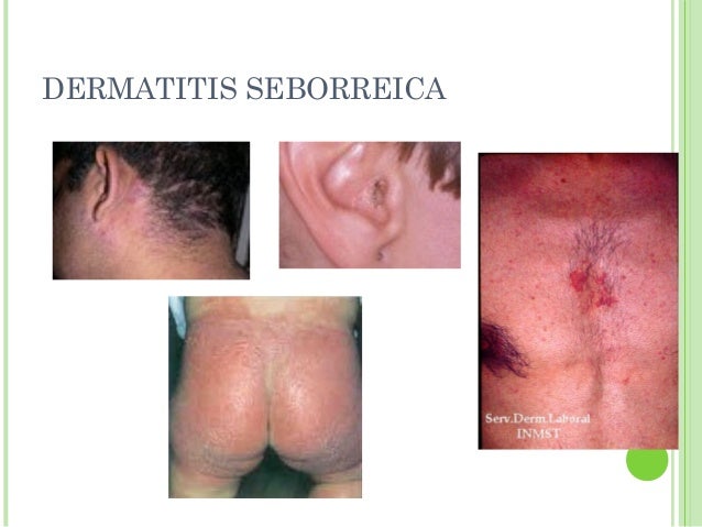 Dermatitis seborreica tratamiento