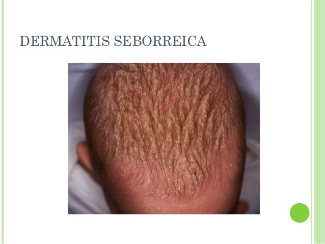 dermatitis seborreica tratamiento cuero cabelludo dermatitis seborreica dermatitis seborreica tratamiento cuero cabelludo dermatitis seborreica