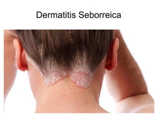 Dermatitis Seborreica
 