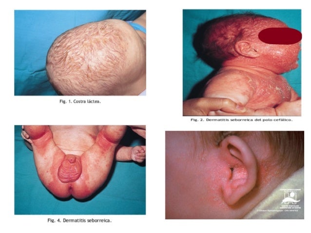 dermatitis seborreica tratamiento cuero cabelludo dermatitis seborreica dermatitis seborreica tratamiento cuero cabelludo dermatitis seborreica